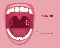 cara rawat tonsil, rawat tonsil, cara tradisional rawat tonsil,